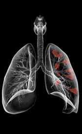 Imagen do câncer de pulmão