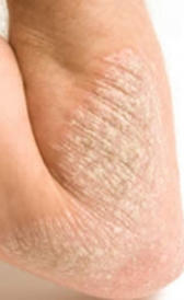 Imagen do eczema