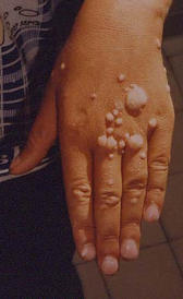 Imagen do papilomavírus humano