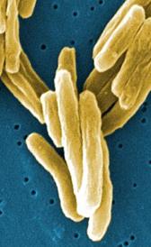 Imagen da tuberculose