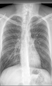 Imagen da doença pulmonar obstrutiva crônica