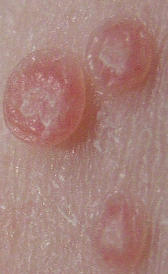 Imagen de la herpes genital