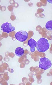 Imagen de la leucemia