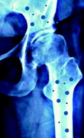Imagen de la osteoporose